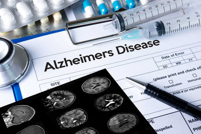 Brain Stimulation Could Assist with treating Alzheimer’s Disease